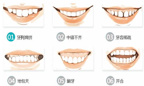 标准牙齿咬合图片_牙齿整齐不代表咬合正常，有这些咬合问题的人建议尽早矫正（牙齿整齐但咬合不好）