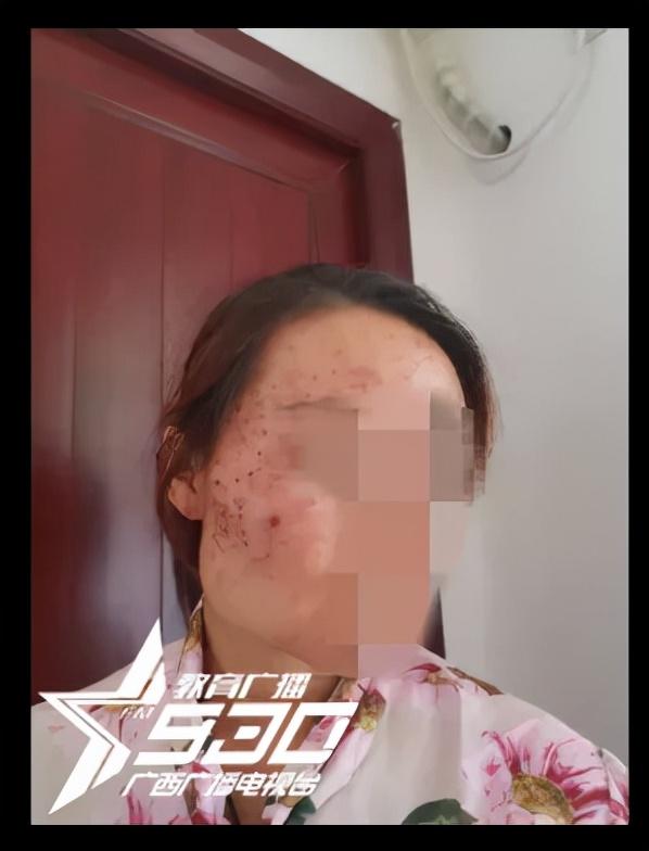 承诺不能95%祛斑就全额退款，南宁市民消费万元后反而烂脸