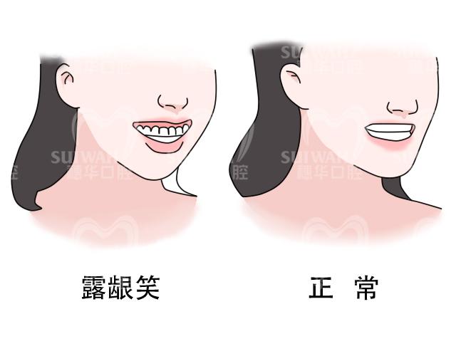 标准牙齿咬合图片_牙齿矫正案例分享：骨性I类开颌矫治，有图有真相（骨性开颌能矫正牙齿吗）